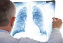Bệnh lao phổi và những vấn đề ai cũng cần biết