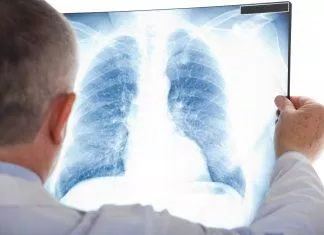 Bệnh lao phổi và những vấn đề ai cũng cần biết
