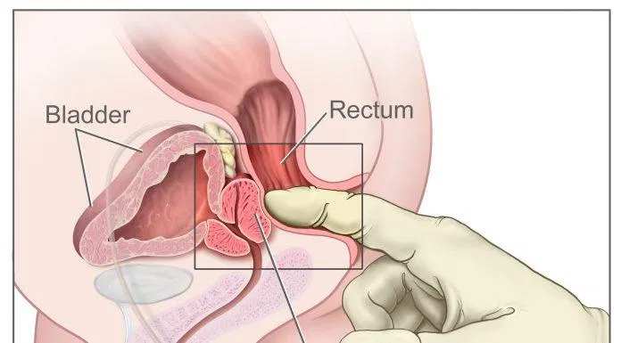 Phì đại tuyến tiền liệt