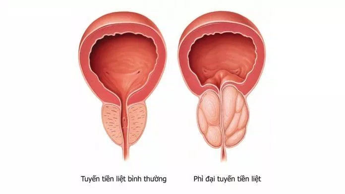 Phì đại tuyến tiền liệt