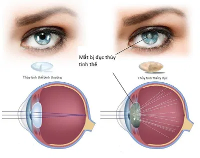 Đục thủy tinh thể