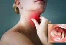 dị vật đường ăn