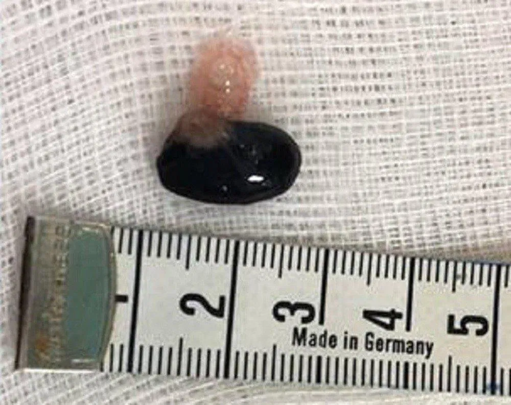 dị vật đường thở