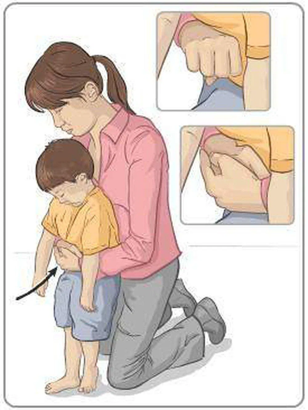 nghiệm pháp hemlich