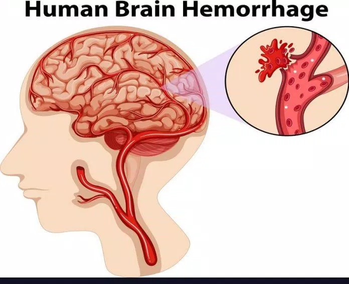 Tai biến mạch máu não