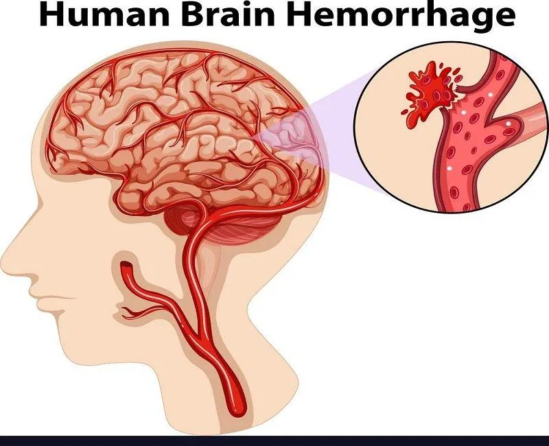 Tai biến mạch máu não