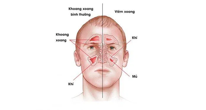 viêm xoang