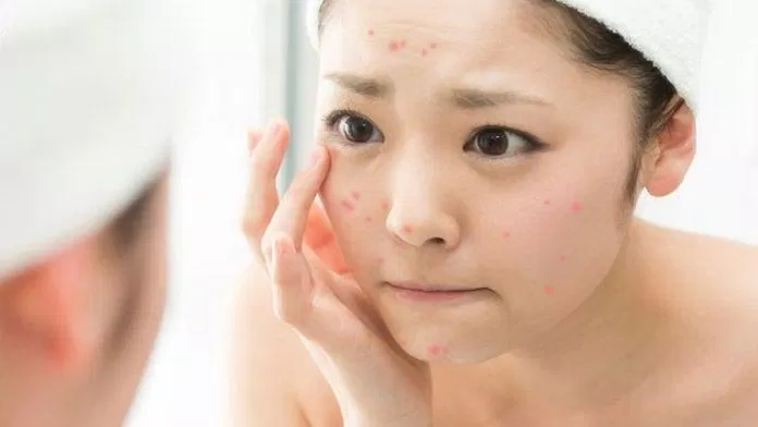 Bạn cần hạn chế chạm tay vào da mặt, tránh lây nhiễm vi khuẩn từ tay sang da mặt, gây tình trạng kích ứng viêm mụn nặng hơn. (Ảnh: Internet)