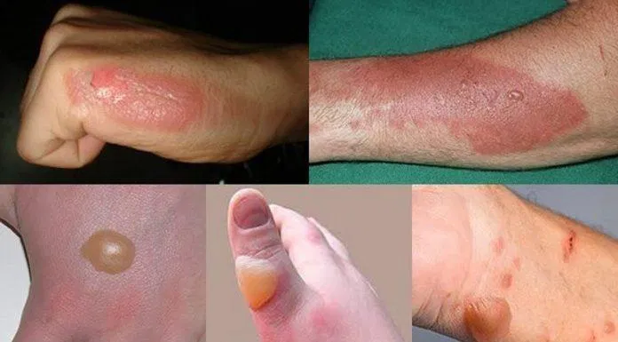 điều trị bỏng