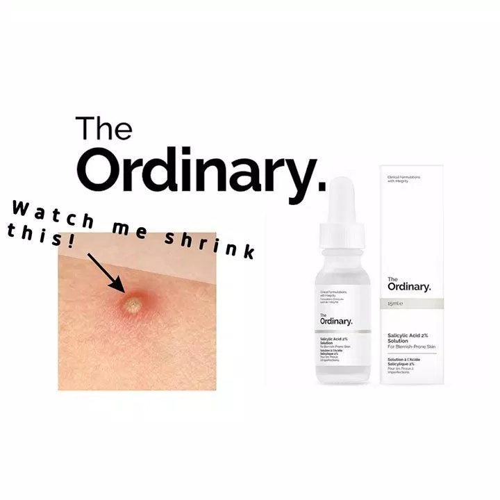 Tinh chất trị mụn The Ordinary Salicylic Acid 2% Solution có khả năng trị mụn rất tốt. (nguồn: Internet)
