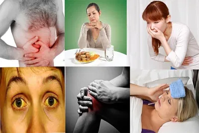 Triệu chứng viêm gan C Triệu chứng viêm gan C