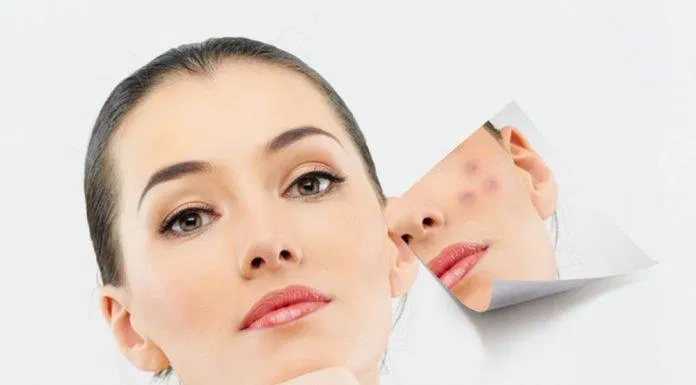 Sản phẩm có tác dụng kháng khuẩn, điều tiết dầu thừa, trị mụn và xóa mờ vết thâm sau mụn (ảnh: internet).