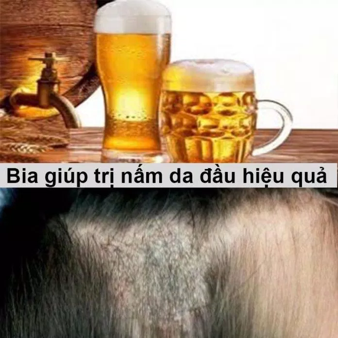 Cách trị nấm da đầu bằng bia (Nguồn: Internet)