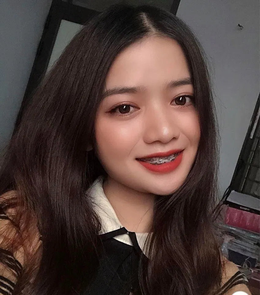 Niềng răng có bị hóp má không?