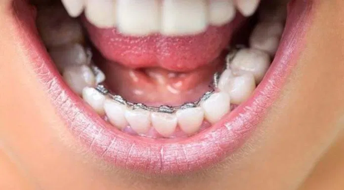 Niềng răng mắc cài mặt trong