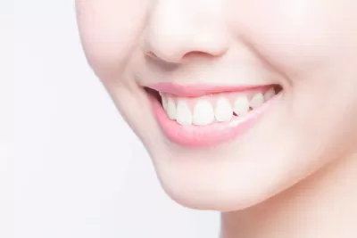 Ưu điểm của niềng răng