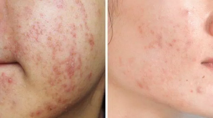 Biểu hiện của da dính kem trộn (bên trái) và da sau mụn (bên phải). (Nguồn: BlogAnChoi).