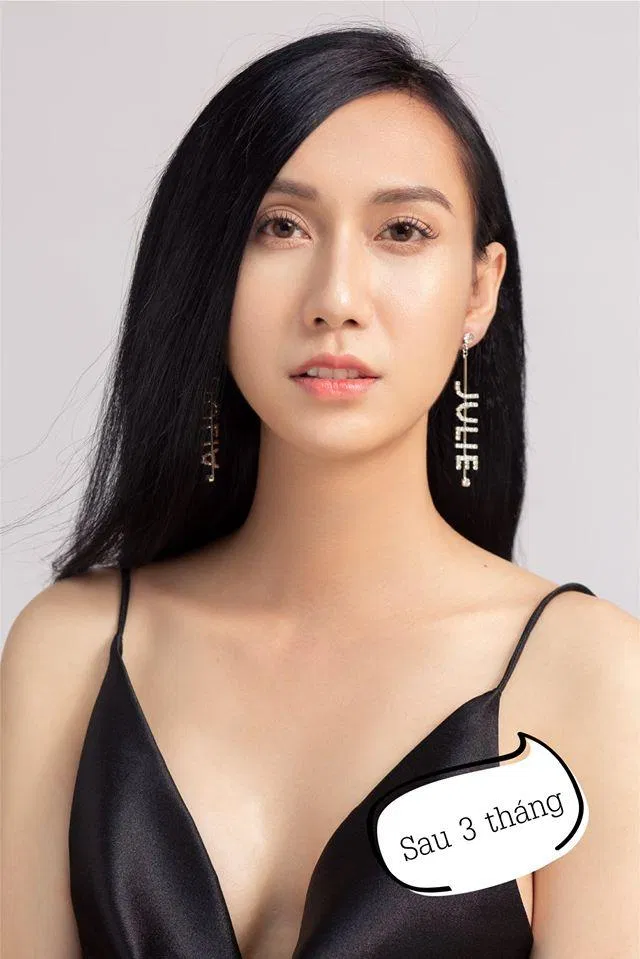 Sau 3 tháng phẫu thuật (Nguồn: Internet)