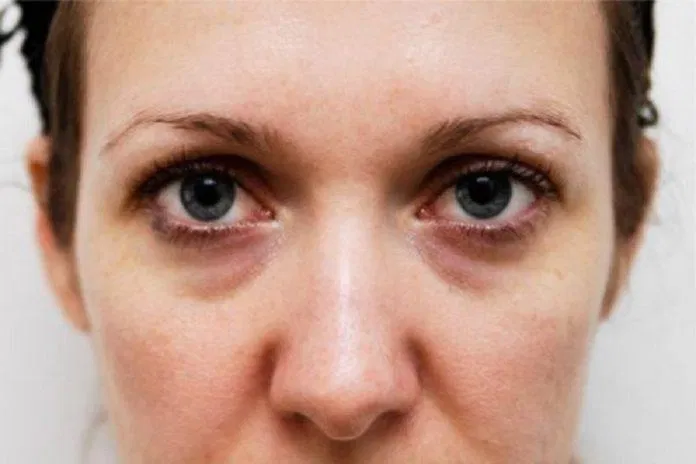 Nguyên nhân và cách giảm quầng thâm mắt ngay tại nhà kem dưỡng mắt kem dưỡng mắt 3W Clinic Collagen Whitening Eye Cream kem mắt ahc kem mắt AHC Ageless Real Eye Cream For Face kem mắt Clinique kem mắt clinique All About Eyes quầng thâm mắt thiên nhiên xóa quầng thâm mắt