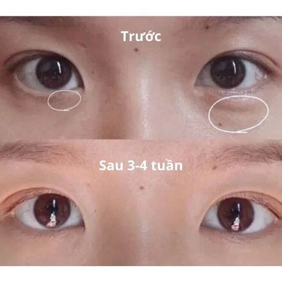 The Ordinary Caffeine Solutions 5% + EGCG giúp trị thâm mắt, nhăn mắt và bọng mắt hiệu quả. (Nguồn: BlogAnChoi).