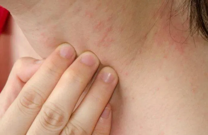 Cơ địa hay mẩn ngứa cũng sẽ khiến da trở nên nhạy cảm hơn (Nguồn: Internet)