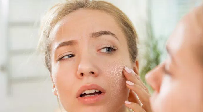 Sử dụng Salicylic Acid có thể khiến da bạn bị khô và châm chích nhé. (Nguồn: Internet).