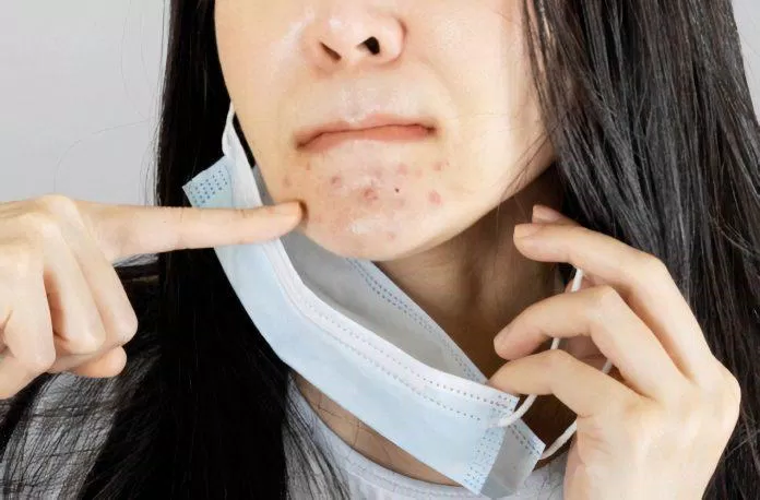 Xóa tan nỗi âu lo đeo khẩu trang bị mụn mà ai ai cũng dễ gặp phải Axit salicylic Banila Co Clean It Zero Bảo vệ bảo vệ da Benzoyl Pedoxide Bioderma Micellaire Solution Ceramides chăm sóc da mụn chăm sóc da nhẹ dịu Covid covid-19 Curél Intensive Moisture Care da nhạy cảm DHC Deep Cleansing Oil đeo khẩu trang đeo khẩu trang bị mụn điều trị mụn Glycolic Acid hyaluronic acid Innisfree Green Tea Foam Cleanser khẩu trang khẩu trang sạch làm sạch sâu Lỗ chân lông Medik8 Hydr8 B5 Liquid Rehydration Serum Mụn mụn khẩu trang Naruko Tea Tree Purifying Clay Mask Cleanser Neutrogena Oil Free Acne Wash Niacinamide Pixi Retinol Tonic retinol rửa mặt đúng cách Salicyclic Acid sản phẩm Skinceuticals Physical Fusion UV Defense SPF 50 sức khỏe da tình trạng da trị mụn