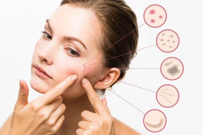 Việc tự nặn mụn không đúng cách cũng chính là một nguyên nhân gây ra sẹo mụn. (Nguồn: Internet).