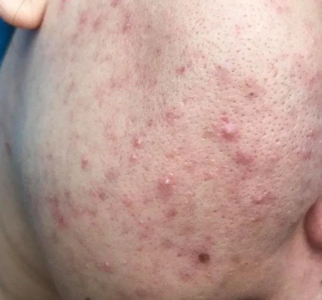 Teana Super Peptides Anti-Redness hiệu quả đối với các làn mụn sưng viêm, luôn bị ửng đỏ do tình trạng mụn kéo dài. (nguồn: Internet) Teana Super Peptides Anti-Redness hiệu quả đối với các làn mụn sưng viêm, luôn bị ửng đỏ do tình trạng mụn kéo dài. (nguồn: Internet)