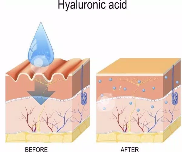 Hyaluronic Acid hoạt động bằng cách lấp đầy các lỗ trống thiếu collagen gây ra hiện tượng lão hóa. (Nguồn : Internet).