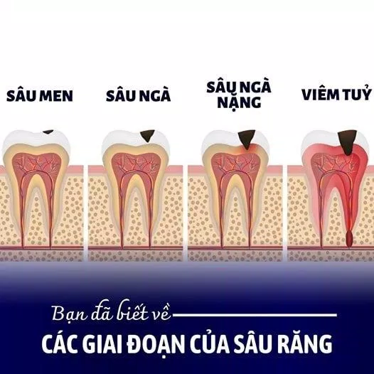 Sâu răng diễn tiến qua các giai đoạn từ ngoài vào trong: sâu men, sâu ngà rồi viêm tủy (Ảnh: Internet). Sâu răng diễn tiến qua các giai đoạn từ ngoài vào trong: sâu men, sâu ngà rồi viêm tủy (Ảnh: Internet).