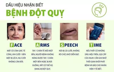 Dấu hiệu nhận biết đột quỵ F.A.S.T (Ảnh: Internet). Dấu hiệu nhận biết đột quỵ F.A.S.T (Ảnh: Internet).
