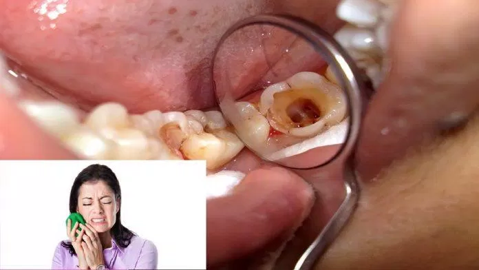 Có phải cứ bị đau thì mới là sâu răng? (Ảnh: Internet). Có phải cứ bị đau thì mới là sâu răng? (Ảnh: Internet).