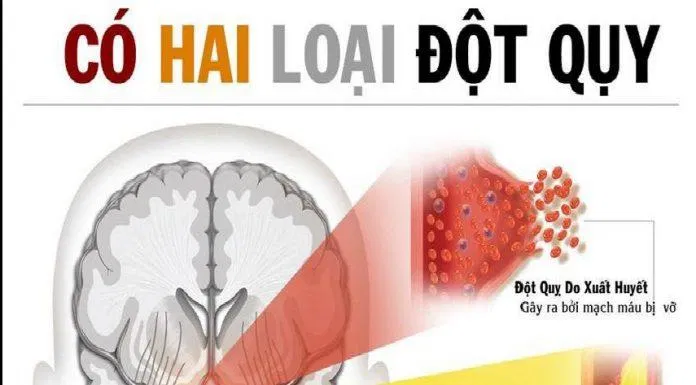 2 loại đột quỵ chính (Ảnh: Internet). 2 loại đột quỵ chính (Ảnh: Internet).