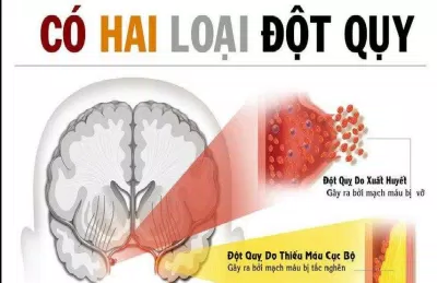2 loại đột quỵ chính (Ảnh: Internet). 2 loại đột quỵ chính (Ảnh: Internet).