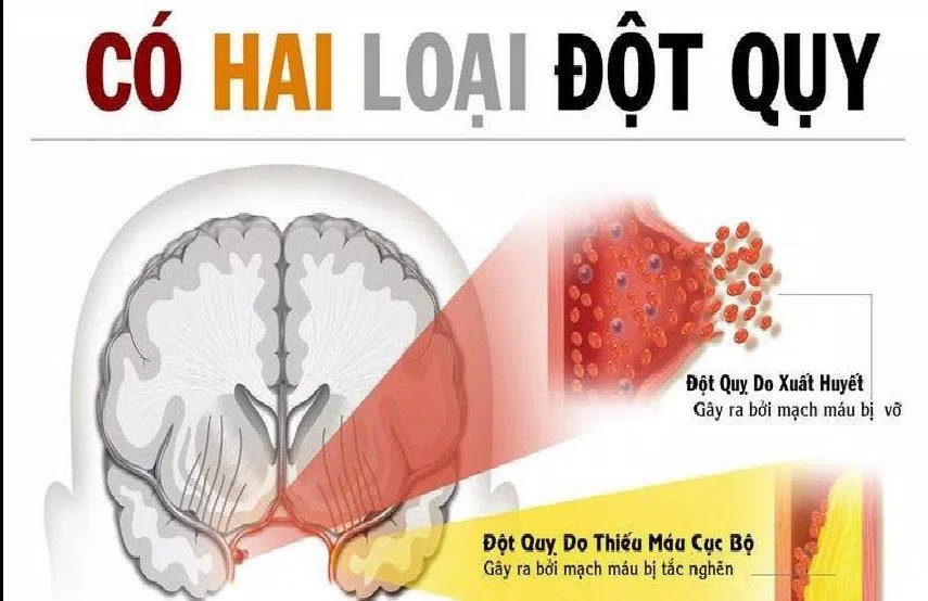 2 loại đột quỵ chính (Ảnh: Internet).