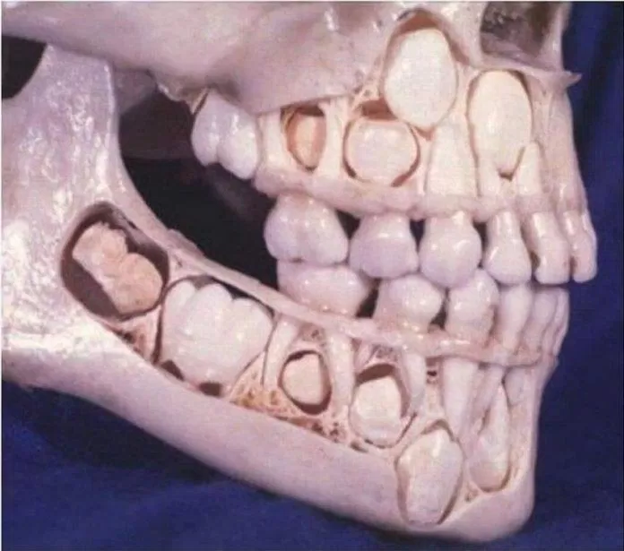 Bên dưới mỗi răng sữa đều có mầm răng vĩnh viễn sau này sẽ trồi lên (Ảnh: Internet).