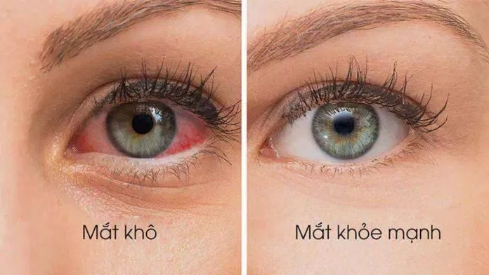 Lưu ý tình trạng mắt khô (Nguồn: Internet).