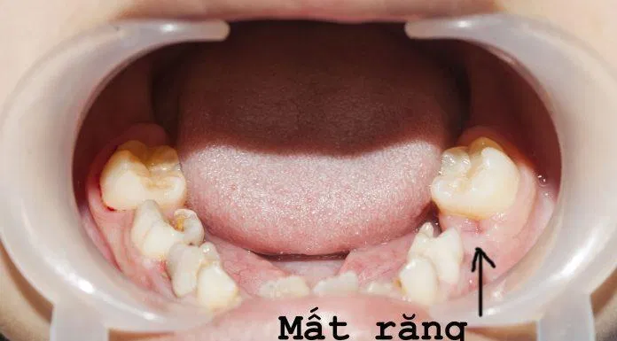 Răng sữa giúp xác định vị trí của răng vĩnh viễn sau này để bạn có hàm răng đều, đẹp (Ảnh: Internet). Răng sữa giúp xác định vị trí của răng vĩnh viễn sau này để bạn có hàm răng đều, đẹp (Ảnh: Internet).