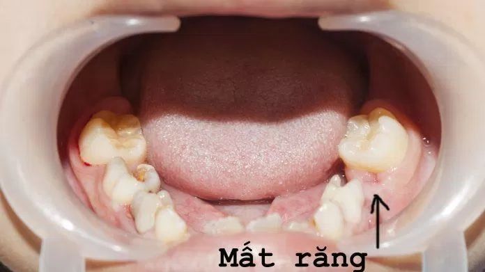 Răng sữa giúp xác định vị trí của răng vĩnh viễn sau này để bạn có hàm răng đều, đẹp (Ảnh: Internet).