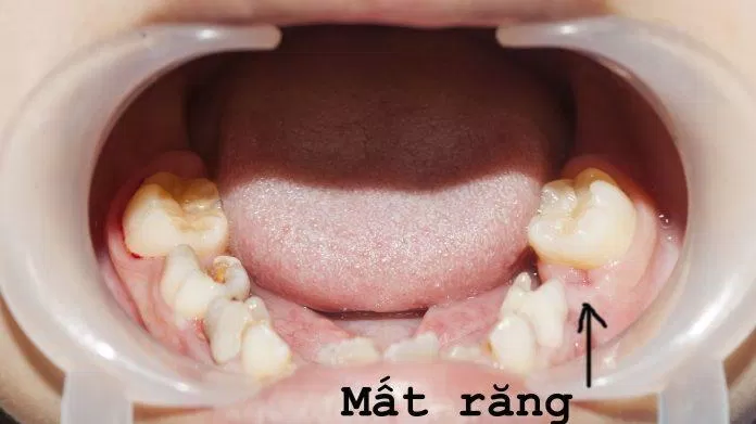 Răng sữa giúp xác định vị trí của răng vĩnh viễn sau này để bạn có hàm răng đều, đẹp (Ảnh: Internet). Răng sữa giúp xác định vị trí của răng vĩnh viễn sau này để bạn có hàm răng đều, đẹp (Ảnh: Internet).