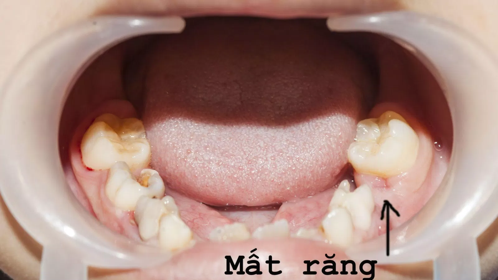 Răng sữa giúp xác định vị trí của răng vĩnh viễn sau này để bạn có hàm răng đều, đẹp (Ảnh: Internet). Răng sữa giúp xác định vị trí của răng vĩnh viễn sau này để bạn có hàm răng đều, đẹp (Ảnh: Internet).