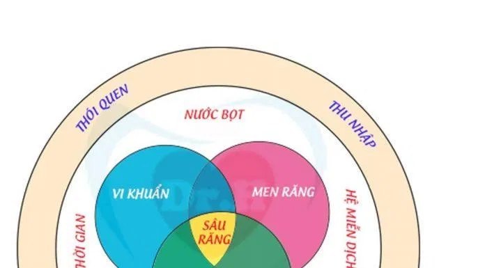 Sơ đồ Keyes tóm gọn các yếu tố gây sâu răng bằng hình ảnh trực quan (Ảnh: Internet). Sơ đồ Keyes tóm gọn các yếu tố gây sâu răng bằng hình ảnh trực quan (Ảnh: Internet).