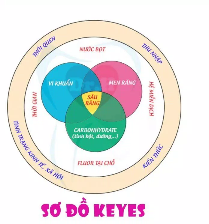 Sơ đồ Keyes tóm gọn các yếu tố gây sâu răng bằng hình ảnh trực quan (Ảnh: Internet). Sơ đồ Keyes tóm gọn các yếu tố gây sâu răng bằng hình ảnh trực quan (Ảnh: Internet).