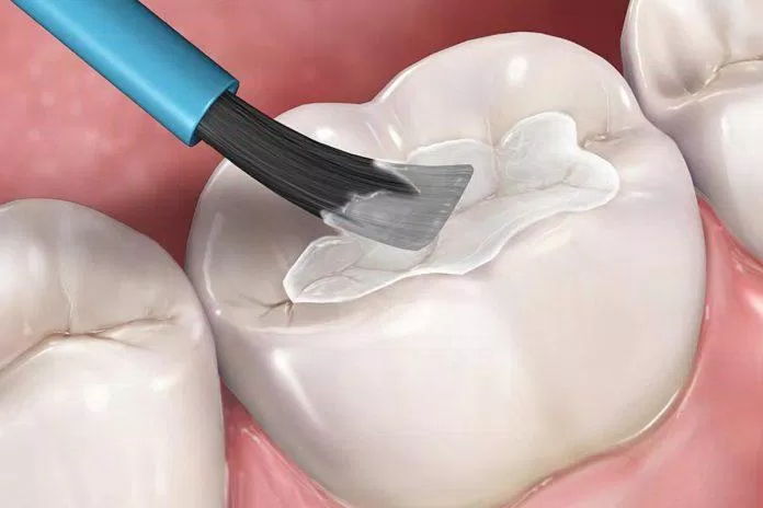 Trám răng liệu có phải là "thuốc tiên" giúp phòng chống sâu răng? (Ảnh: Internet).