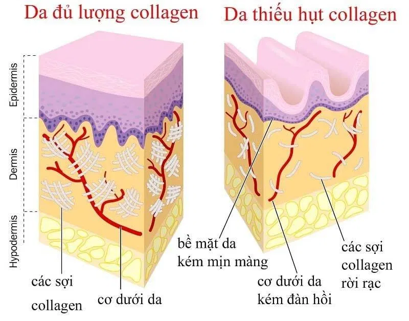Thiếu hụt collagen là nguyên nhân chủ yếu khiến da lão hóa sớm và kém sức sống. (Nguồn: Internet)