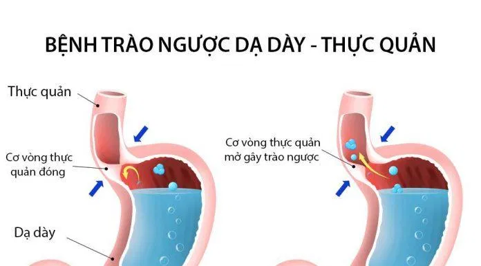 Nguyên nhân của bệnh trào ngược dạ dày thực quản (Nguồn: Internet). Nguyên nhân của bệnh trào ngược dạ dày thực quản (Nguồn: Internet).