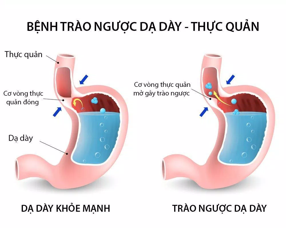 Nguyên nhân của bệnh trào ngược dạ dày thực quản (Nguồn: Internet).