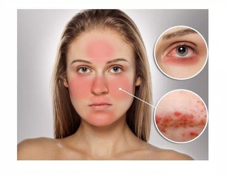 Da nhạy cảm không nên lựa chọn kem chống nắng dạng hóa học (Nguồn: Interent)