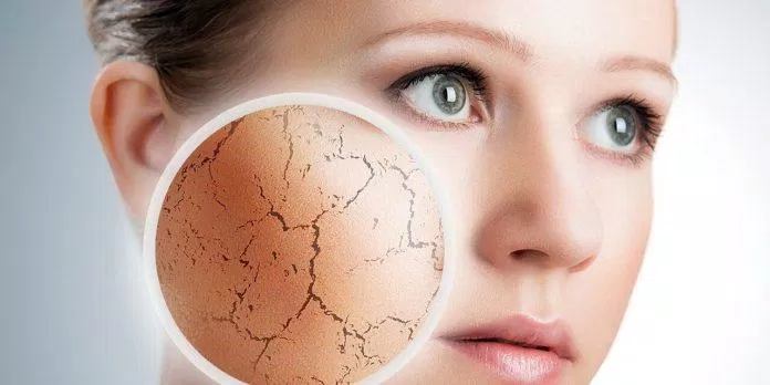 Nếu không cẩn thận làn da sẽ dễ gặp kích ứng khi mới dùng retinol (Nguồn: Internet).